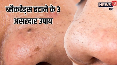 Blackheads Keep Coming Back? Expert Reveals 3 Effective Deep Pore Cleansing Methods.