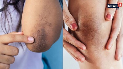  इसके नियमित इस्तेमाल से आपके घुटनों और कोहनी का कालापन धीरे-धीरे गायब हो जाएगा और त्वचा मुलायम व साफ नजर आने लगेगी. (AI Image)