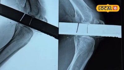 PBM Hospital Bikaner: 28-inch iron rod removed from knee in complex two-hour surgery, leg saved.