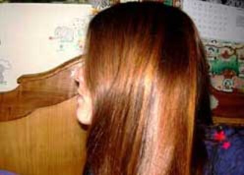 Homeopathy gives hope to patients suffering hair loss Homeopathy gives hope to patients suffering hair loss