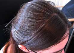 Treatment for the symptoms of alopecia | Isdin | ISDIN