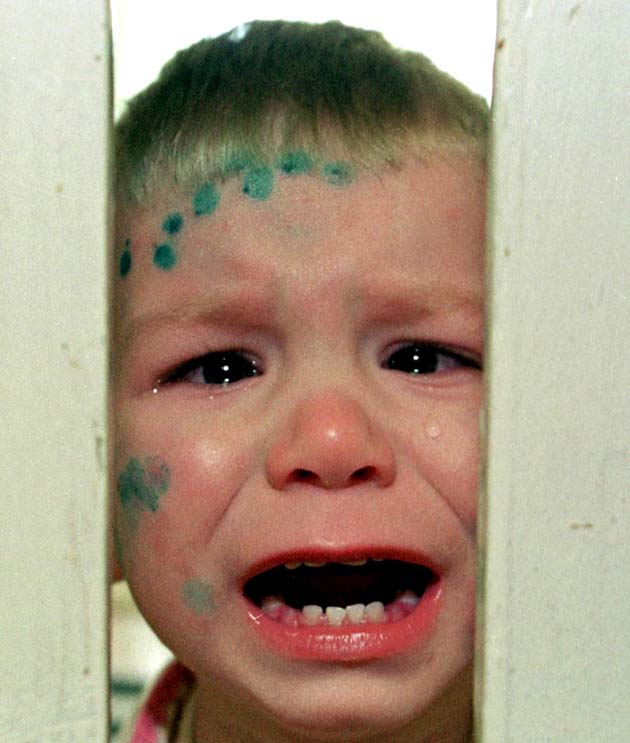 Hiv Aids Pictures Of Victims