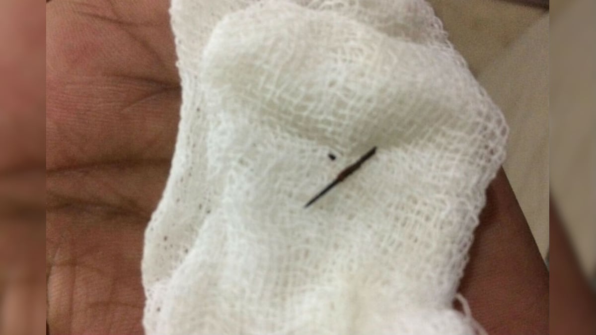 Sewing Needle Removed from Kerala Man's Body After 22 Years News18
