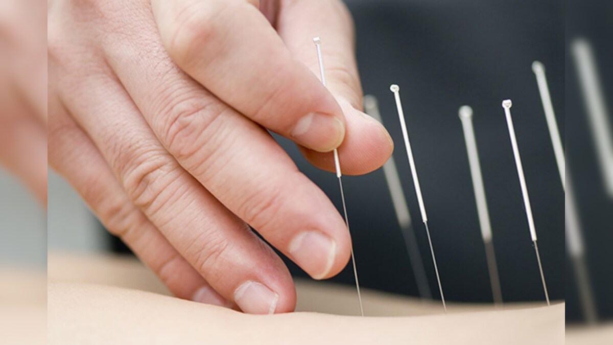 Thinking of Consulting an Acupuncturist This Fall? News18