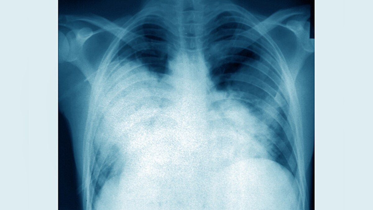 interstitium-one-of-the-largest-human-organs-has-been-discovered-news18