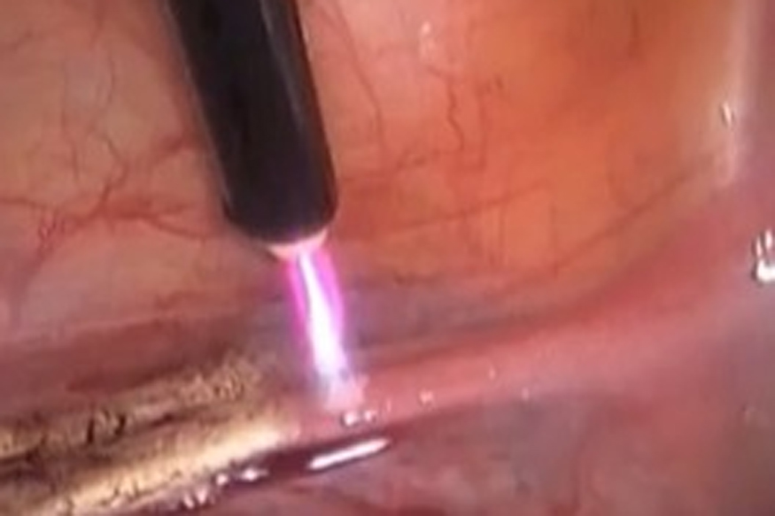 Arrogant Uk Surgeon Burned Initials Onto Patients Livers
