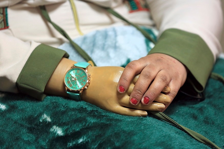 In this Monday, Nov. 5, 2018 photo, Saja Ahmed Saleem, 17, who was injured in an explosion in 2007, holding her artificial hand before her reconstructive surgery in Baghdad, Iraq. Those whom treatment not available at state-run hospitals and can’t afford treatment at private clinics rely on social media to make appeals that grab attention of some surgeons to help them regain a chance at life. (AP Photo/Hadi Mizban)