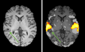 MRI images