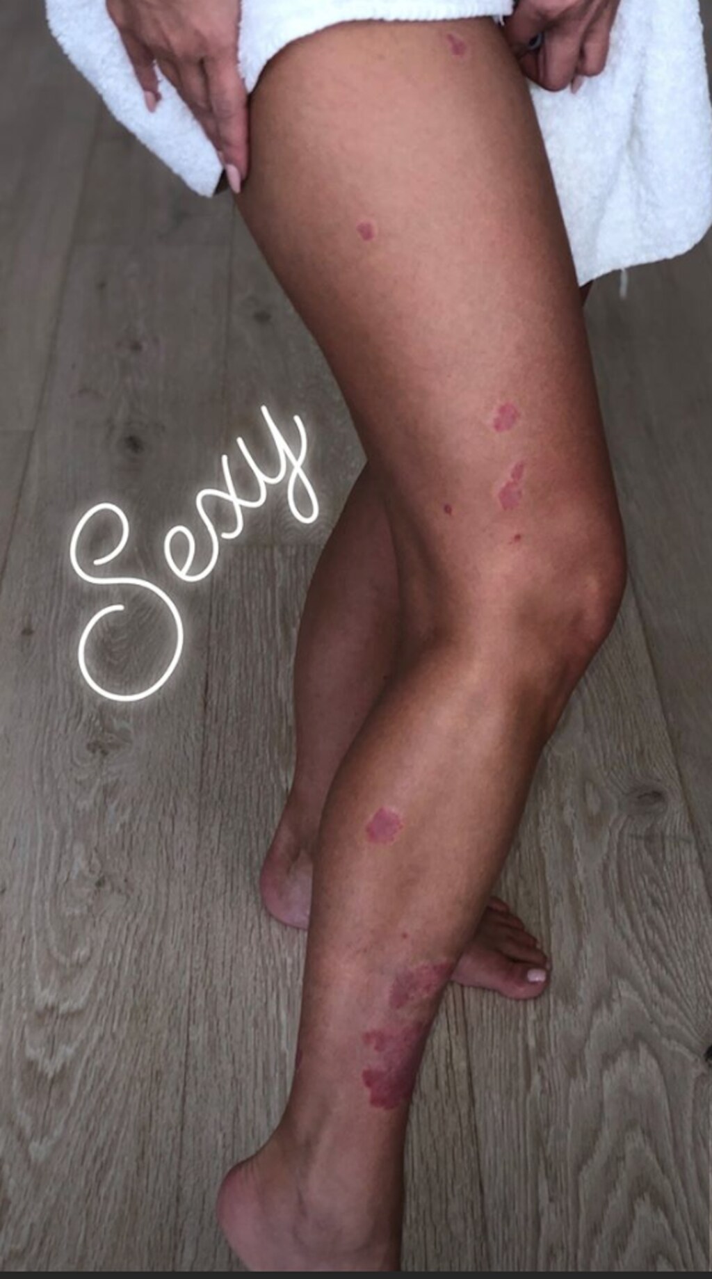kim-kardashian-leg-flare-up