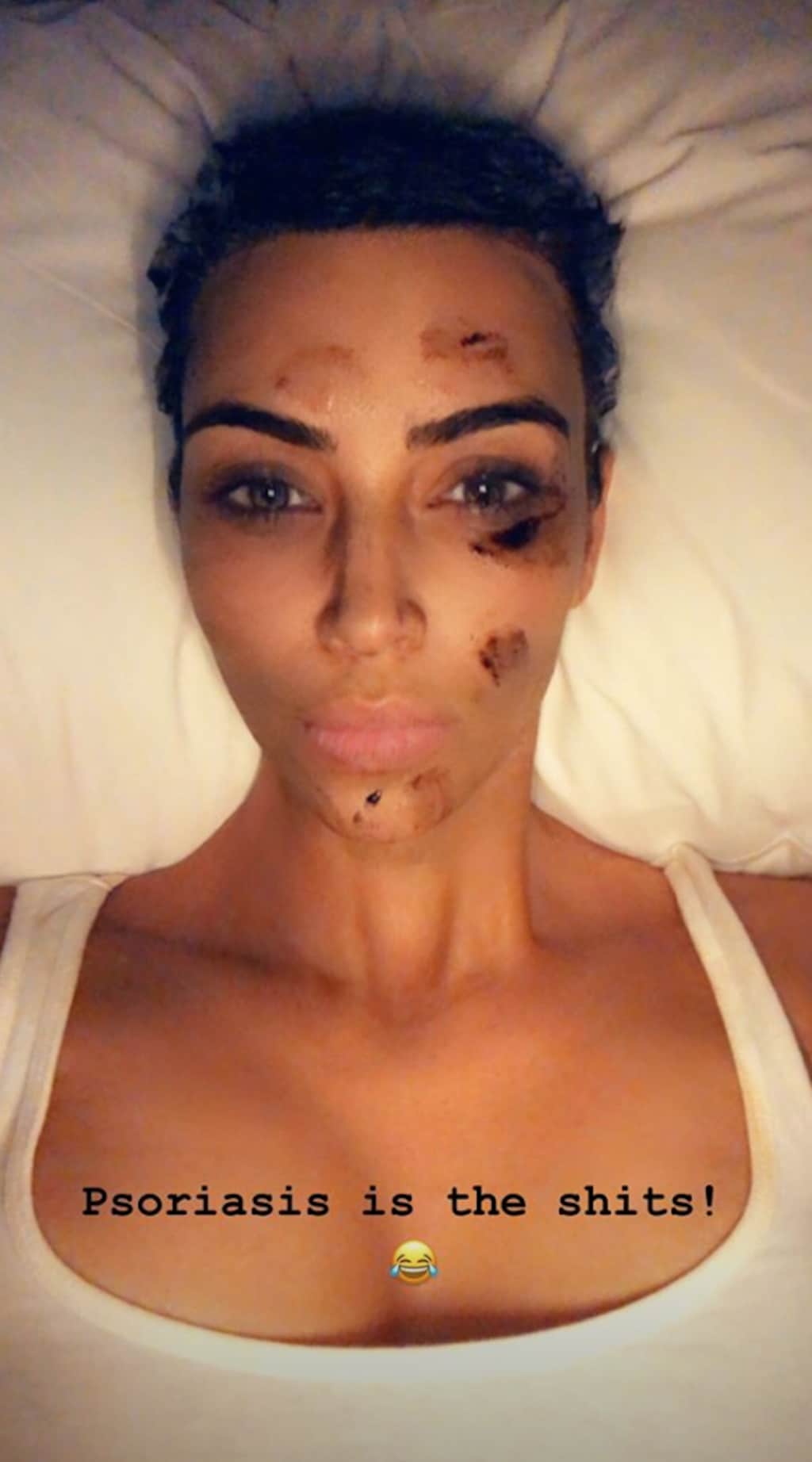 kim-kardashian-psoriasis