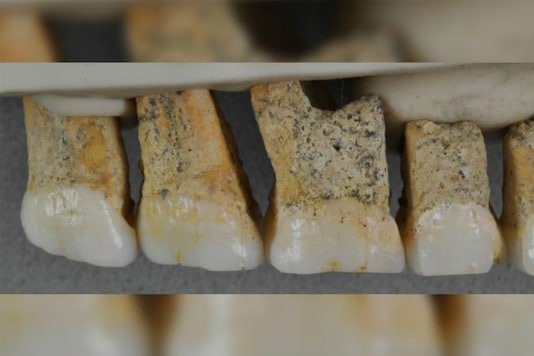 Tooth Found Growing inside Man's Nostrils for Years after He Complains of Blocked Nose Tooth Found Growing inside Man's Nostrils for Years after He Complains of Blocked Nose