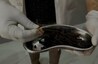‘Stunned’ Doctors Remove Over 100 Nails, Metal Pieces from Rajasthan Man’s Intestines