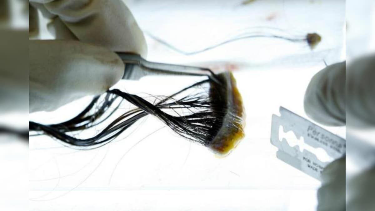 Some Skin Cancers May Start in Hair Follicles, Says Study