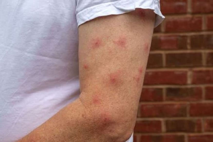 why-do-mosquito-bites-itch-here-s-how-you-can-soothe-them-news18