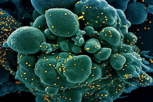 Colorized scanning electron micrograph of an apoptotic cell (green) infected with SARS-COV-2 virus particles (yellow), also known as novel coronavirus, isolated from a patient sample. (Reuters)