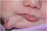 Baby Girl Born with Two Mouths in US Gets Duplicate Oral Cavity Removed
