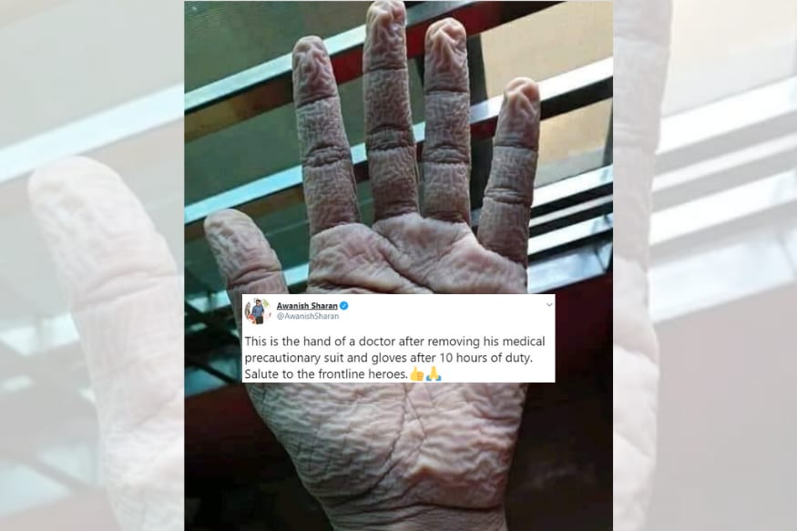 Photo of Doctor's Pruney Hand After Wearing Gloves for 10 Hours ...