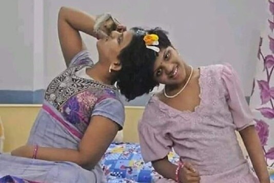 Conjoined Twins Veena Vani (facebook)