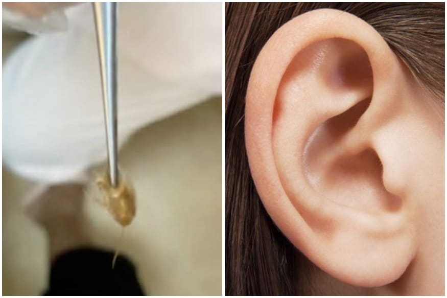 A woman in Southern China recently approached doctors after she had a sharp pain in her ear, accompanied by a constant scratching sound. Upon further,