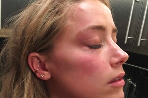 Johnny Depp's Libel Case: Pics of Amber Heard's Bruised Face Shown to Court