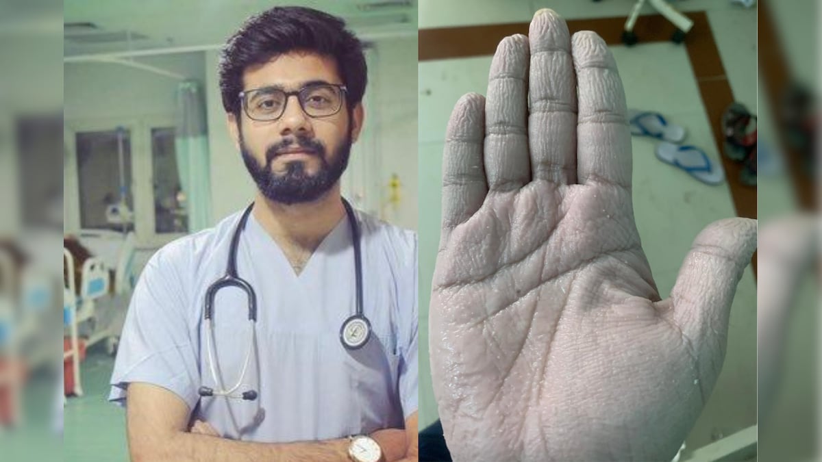 'Can't Take Off Gloves For Over 10 Hours' What Happens to a Doctor's