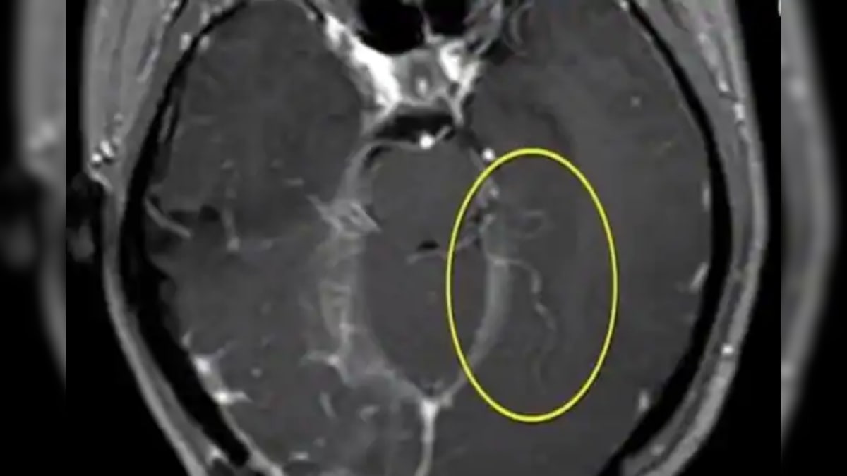 5-Inch Worm That Lived Inside Chinese Man's Brain For 17 Years Removed After Surgery