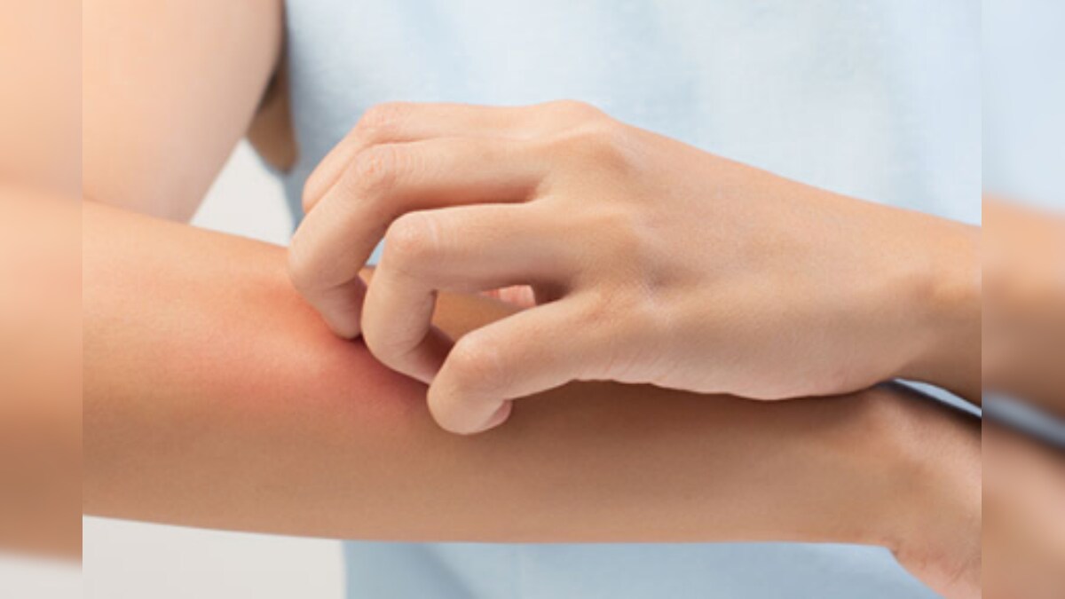 What You Need to Know About Yeast Infections in Hot and Humid Weather News18