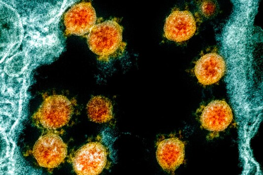 FILE - This electron microscope image made available and color-enhanced by the National Institute of Allergy and Infectious Diseases Integrated Research Facility in Fort Detrick, Md., in 2020, shows Novel Coronavirus SARS-CoV-2 virus particles, orange, isolated from a patient. One of COVID-19's scariest mysteries is why some people are mildly ill or have no symptoms and others rapidly die and scientists are starting to unravel why. (NIAID/National Institutes of Health via AP) FILE - This electron microscope image made available and color-enhanced by the National Institute of Allergy and Infectious Diseases Integrated Research Facility in Fort Detrick, Md., in 2020, shows Novel Coronavirus SARS-CoV-2 virus particles, orange, isolated from a patient. One of COVID-19's scariest mysteries is why some people are mildly ill or have no symptoms and others rapidly die and scientists are starting to unravel why. (NIAID/National Institutes of Health via AP)