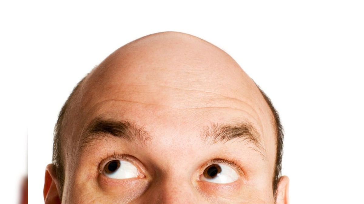 Mumbai Woman Accuses Husband of 'Cheating' for Hiding His Baldness, Files Police Case