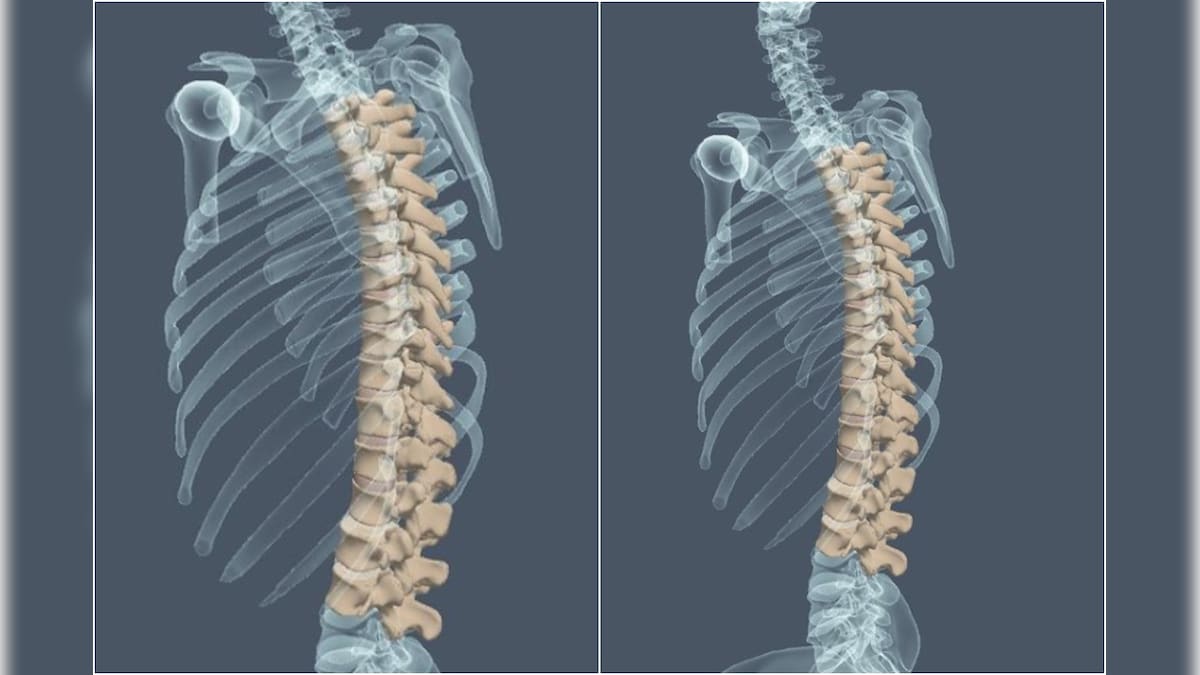 A Silent Spine-related Epidemic Building up, Warns Doctor