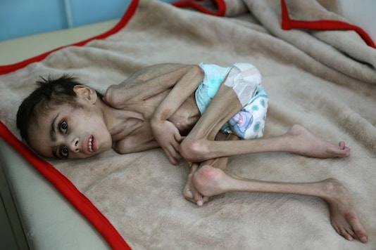 Paralysed and severely malnourished, seven-year-old Faid Samim lies curled up on a hospital bed in the Yemeni capital Sanaa, having barely survived the journey there. “He was almost gone when he arrived but thank God we were able to do what was necessary and he started improving. He is suffering from CP (cerebral palsy) and severe malnutrition,” said Rageh Mohammed, the supervising doctor of the Al-Sabeen hospital’s malnutrition ward. Photo: Reuters