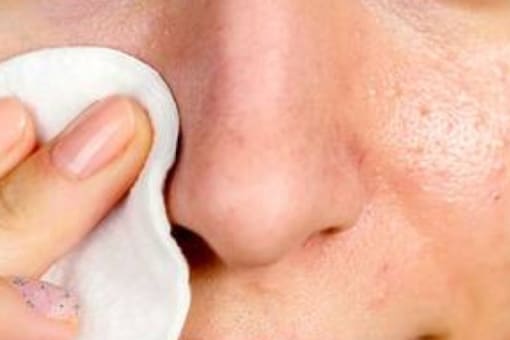 5 Safest Home Remedies to Remove Blackheads