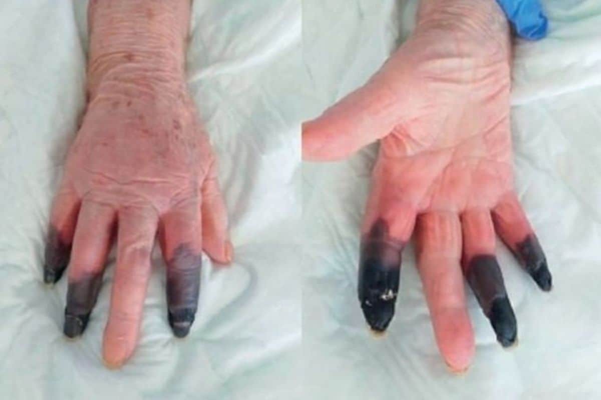 Read more about the article Italian Medical doctors Amputate three Fingers of Covid-19 Constructive Lady After They Flip Black