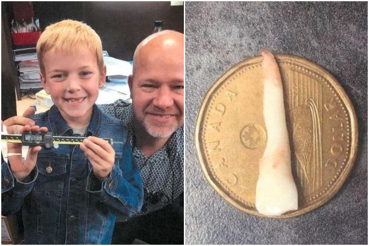 10-year-old Boy from Canada Bags Guinness World Record for Longest Milk Tooth Ever Extracted