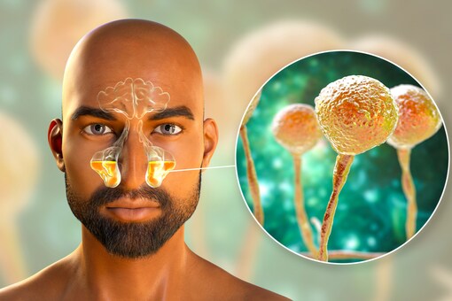 Explained Difference Between Black Fungus White Fungus Yellow Fungus And Green Fungus