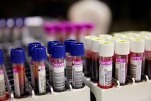 World Sickle Cell Day: Why Genetic Testing is Important to Ward off This Blood Disorder World Sickle Cell Day: Why Genetic Testing is Important to Ward off This Blood Disorder