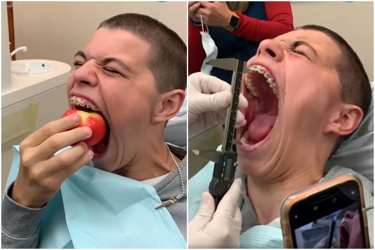 US Teen Reclaims Guinness World Spot for Widest Gaping Mouth, Can Fit