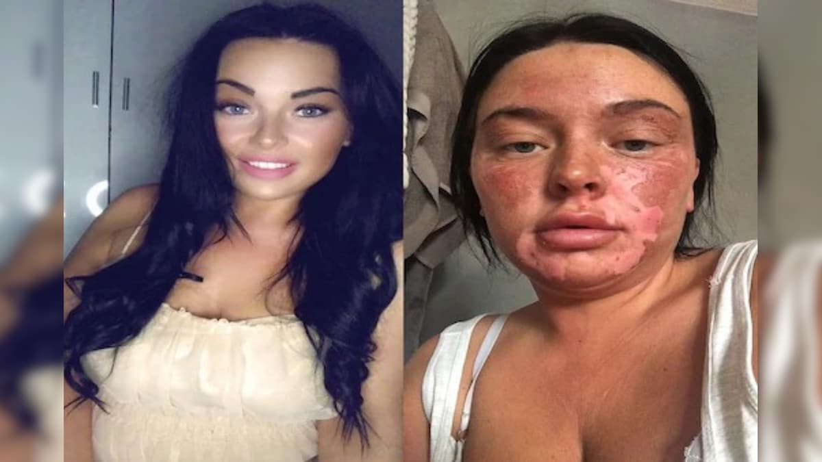 UK Woman Left With Serious Burns After Egg Poaching Hack Goes Wrong