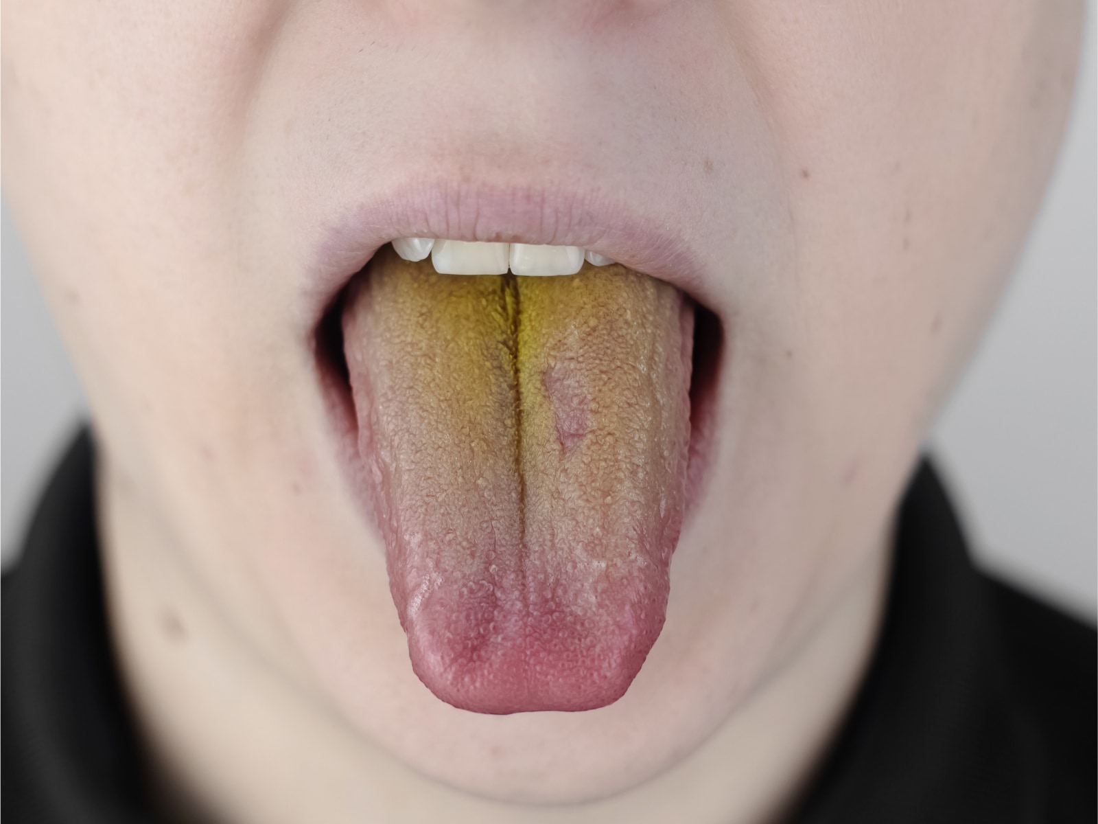 Canadian Boy with Bright Yellow Tongue Diagnosed With Rare 'Epstein-Barr'  Virus