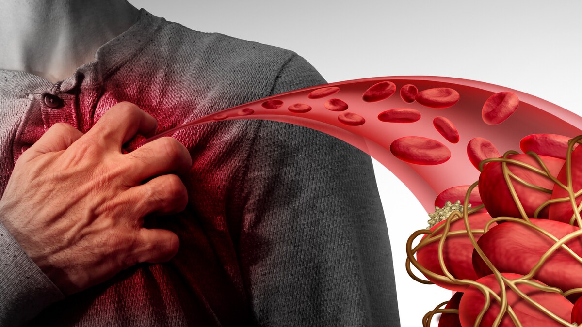 Abnormal Antibody Response Causes Blood Clots in People with Severe