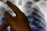Tuberculosis Deaths Rise for First Time in Years, WHO Report Links it to Covid-19