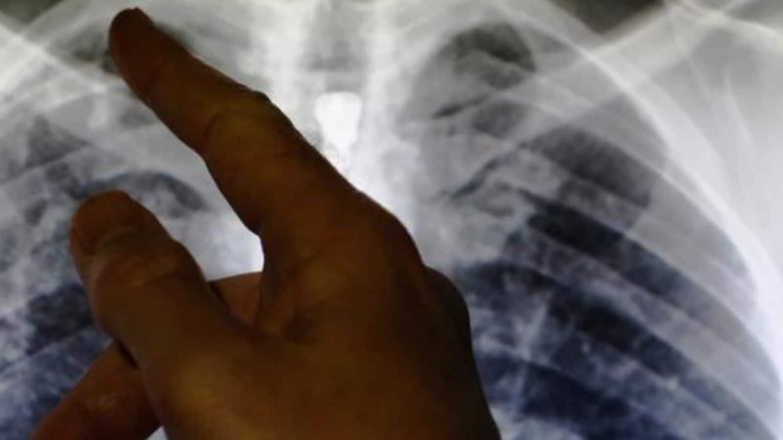 Mumbai Patient Suffering from Drug-resistant TB First in Country to Get