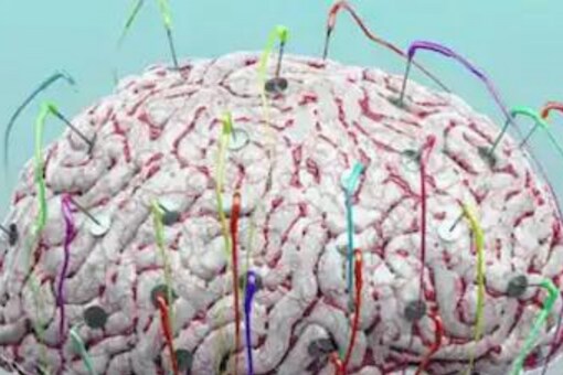 The doctor said that the Induced Pluripotent Stem Cells (iPSCs) were converted into neural stem cells in a tissue culture dish. (Credits: Getty Images)