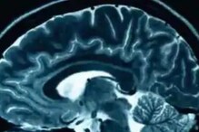 Artificial Intelligence May Help Diagnose Dementia, Says Study