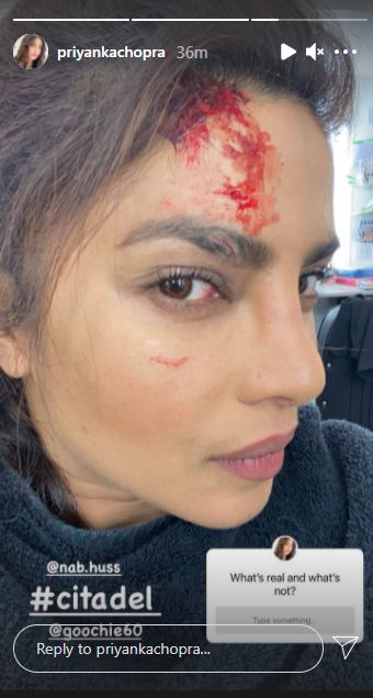 Priyanka Chopra Shares Photo From Citadel&#39;s Set, Asks Fans Whether Her  Injury Marks Are Real