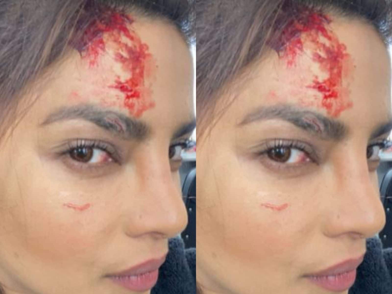 Priyanka Chopra Shares Photo From Citadel's Set, Asks Fans Whether Her  Injury Marks Are Real