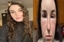 Canadian Girl Ends Up in Hospital After Having Allergic Reaction to Hair Dye