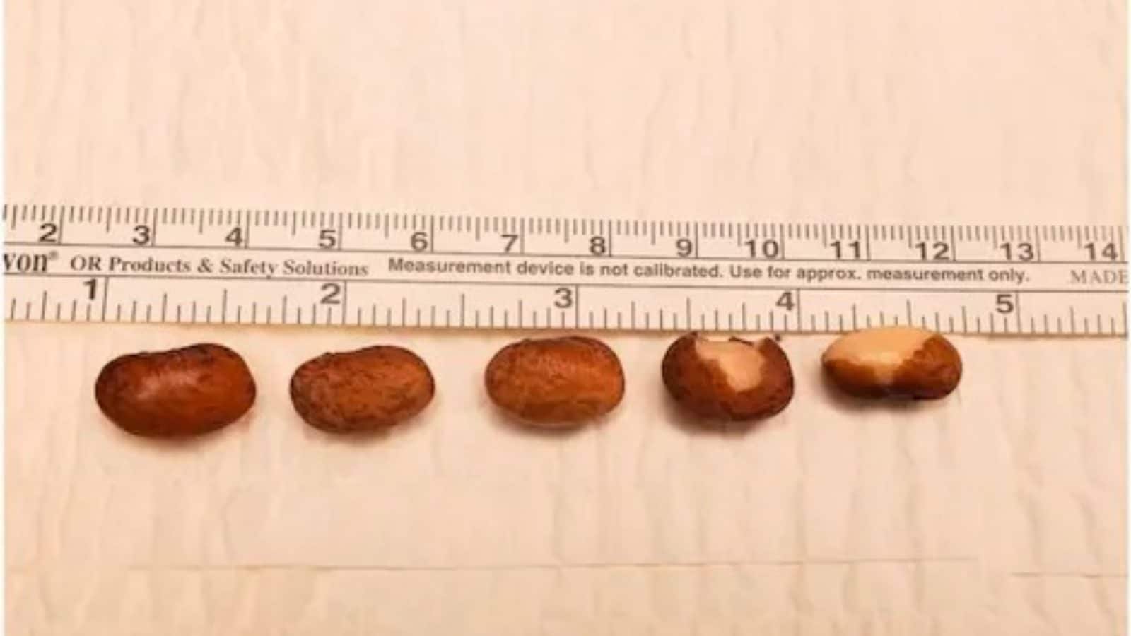 US Man Inserts 6 Kidney Beans in Private Parts for Fun, Lands on Hospital Bed