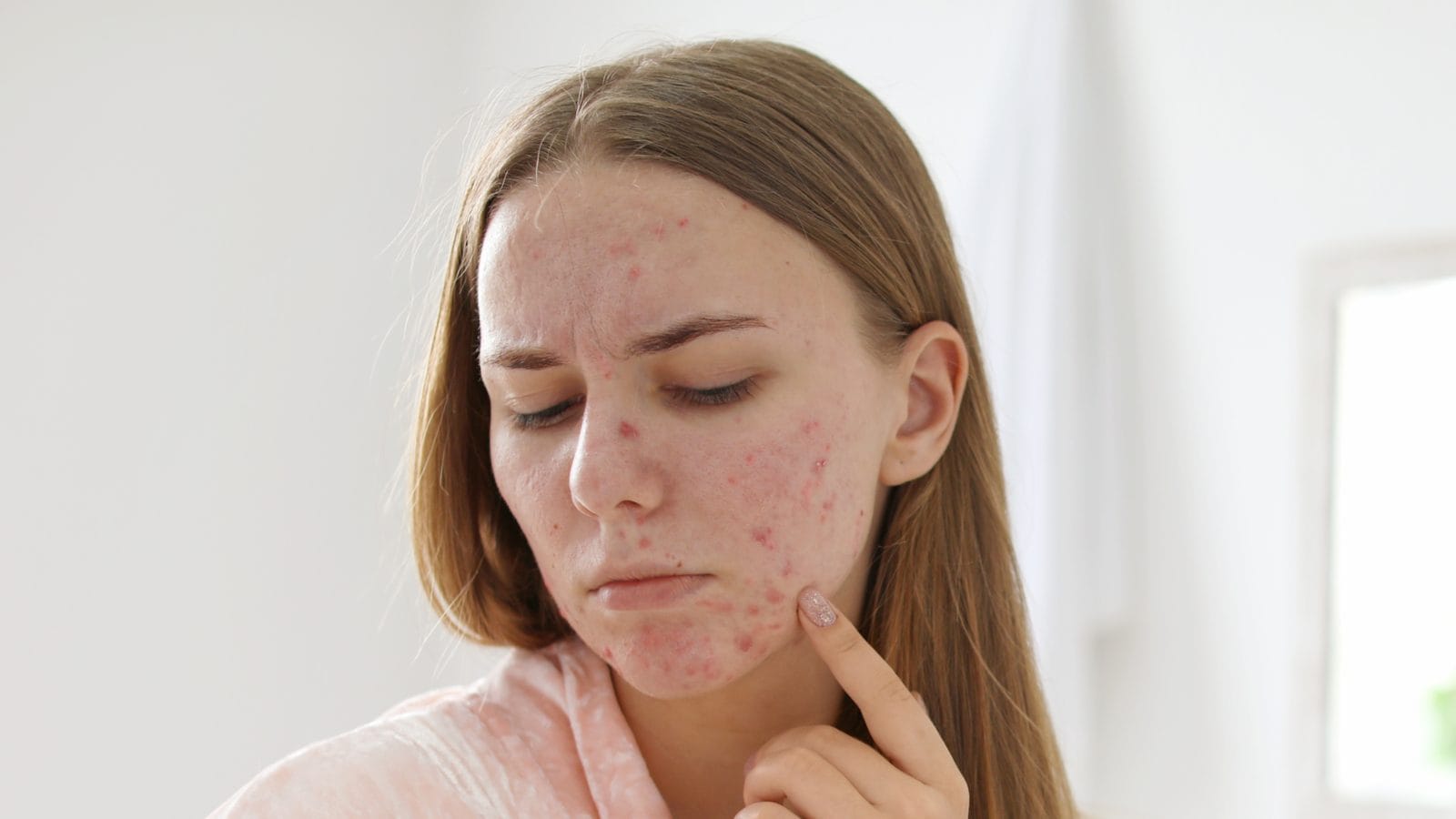 Are You Dealing With Acne? Here Are 4 Skin Tips For Clear And Smooth Skin