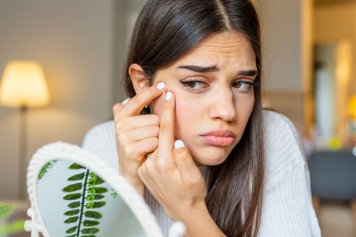 Pimples and acne are the most common skin problems that occur in both men and women (Image: Shutterstock)